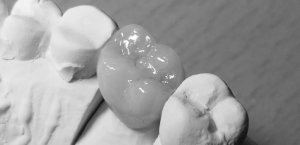 ジルコニア クラウン