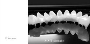 ジルコニア    Bridge　